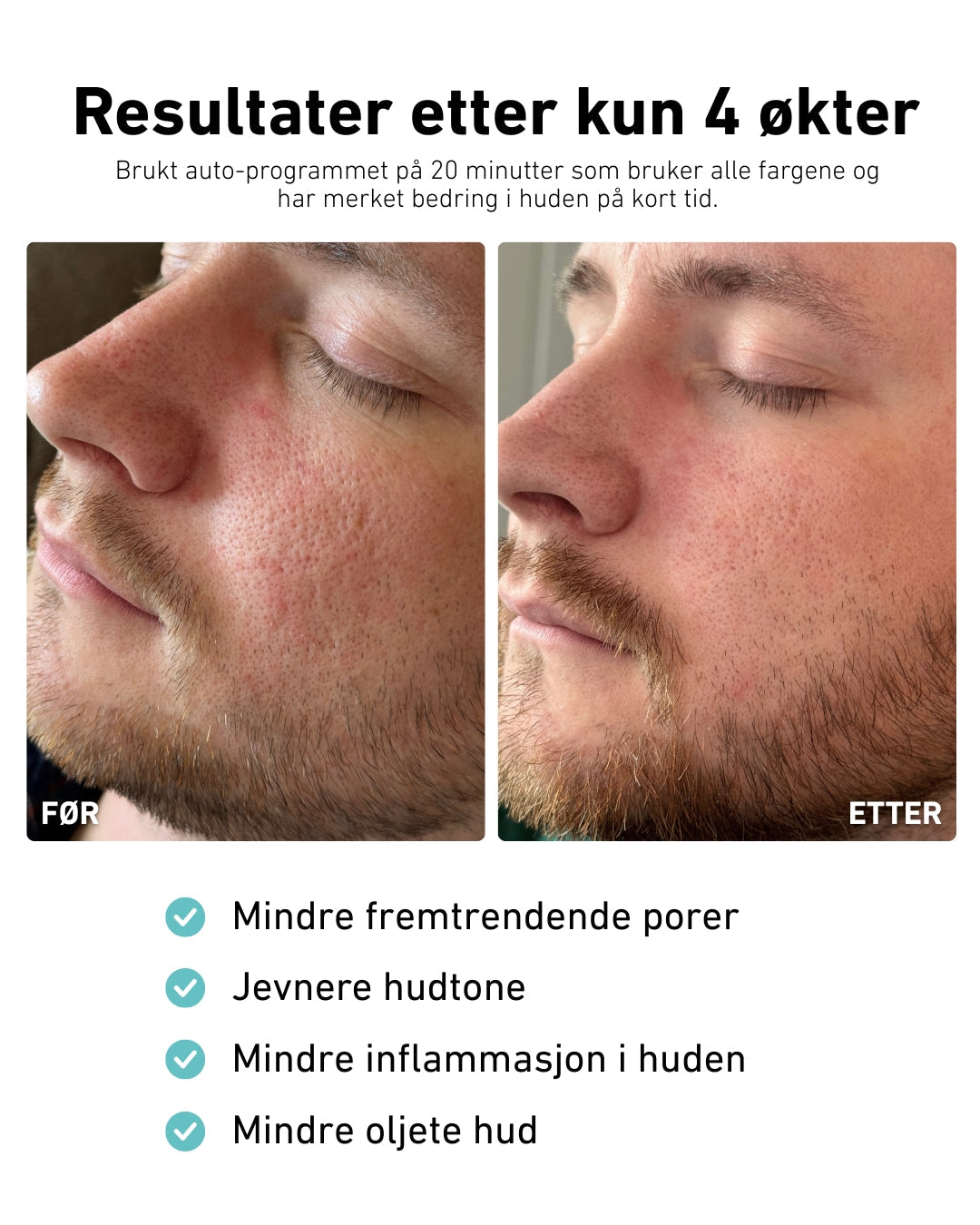 LED-lysmaske til ansikt mot akne, rynker og pigmentflekker