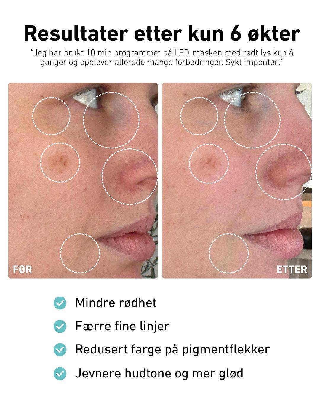 LED-lysmaske til ansikt mot akne, rynker og pigmentflekker
