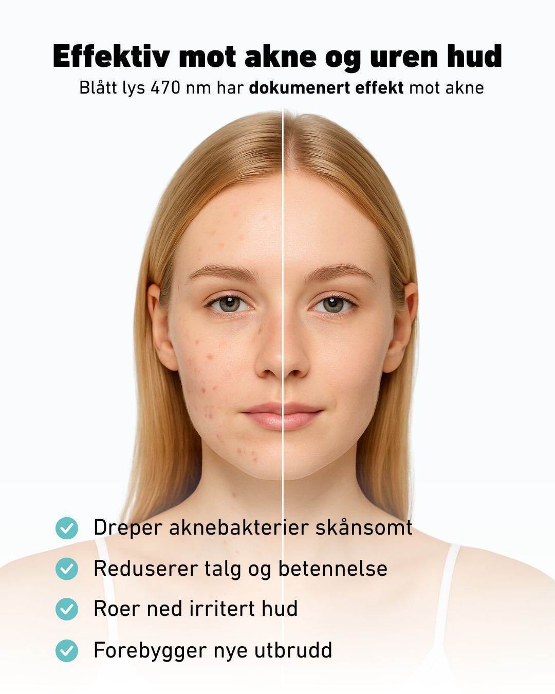 Før-og-etter bilde av ung kvinne med akne, hvor venstre side av ansiktet viser uren hud med kviser og rødhet, og høyre side viser jevn, ren hud. Øverst står teksten ‘Effektiv mot akne og uren hud – Blått lys 470 nm har dokumentert effekt mot akne’. Nederst listes fordelene: dreper aknebakterier skånsomt, reduserer talg og betennelse, roer ned irritert hud og forebygger nye utbrudd.