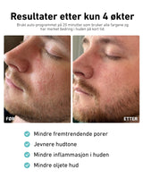 LED-lysmaske til ansikt mot akne, rynker og pigmentflekker