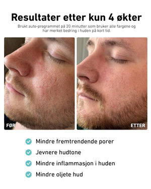 LED-lysmaske til ansikt mot akne, rynker og pigmentflekker