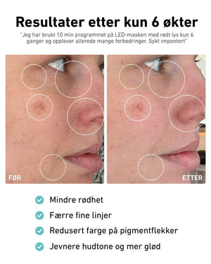 LED-lysmaske til ansikt mot akne, rynker og pigmentflekker