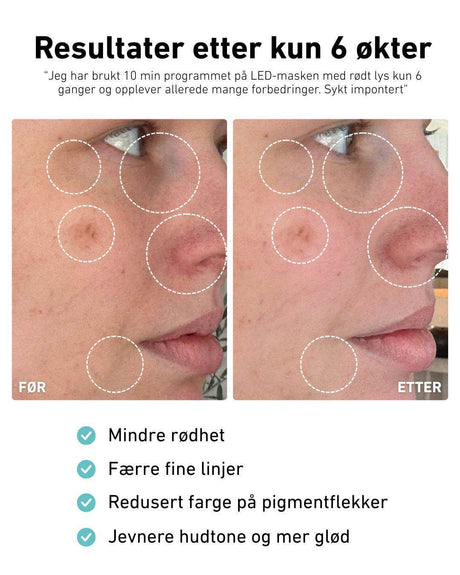 LED-lysmaske til ansikt mot akne, rynker og pigmentflekker