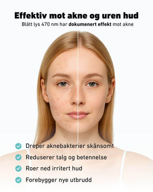 Før-og-etter bilde av ung kvinne med akne, hvor venstre side av ansiktet viser uren hud med kviser og rødhet, og høyre side viser jevn, ren hud. Øverst står teksten ‘Effektiv mot akne og uren hud – Blått lys 470 nm har dokumentert effekt mot akne’. Nederst listes fordelene: dreper aknebakterier skånsomt, reduserer talg og betennelse, roer ned irritert hud og forebygger nye utbrudd.