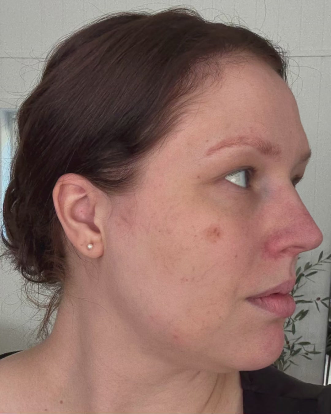 LED-lysmaske til ansikt mot akne, rynker og pigmentflekker